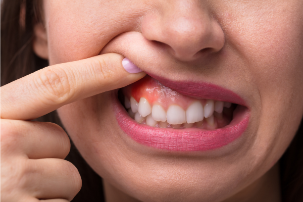 Gum Disease Teatment in Osseo, MN
